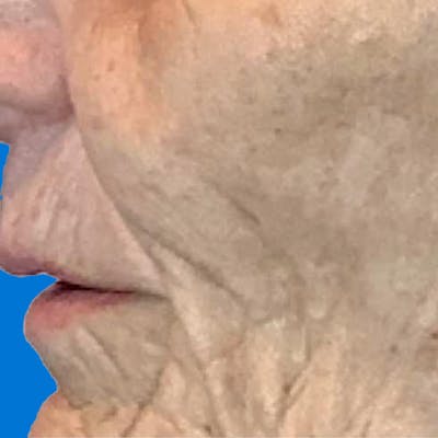 Junera Before & After Gallery - Patient 314253 - Image 1