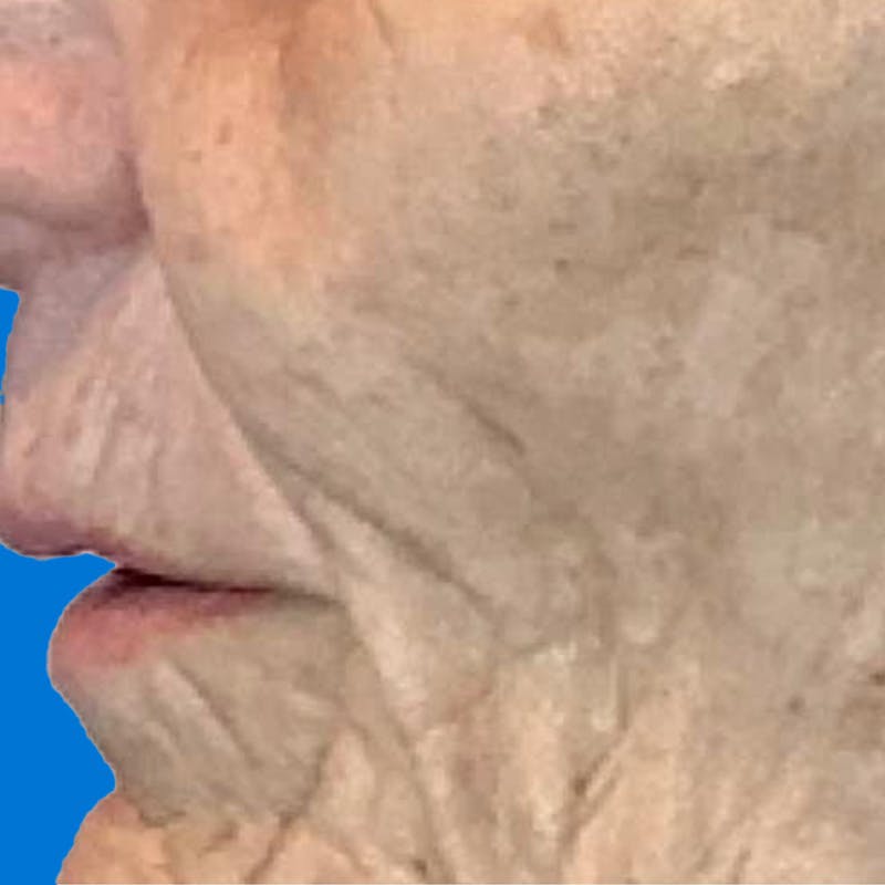 Junera Before & After Gallery - Patient 314253 - Image 1
