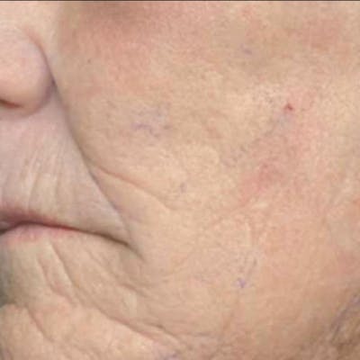 Junera Before & After Gallery - Patient 314253 - Image 2