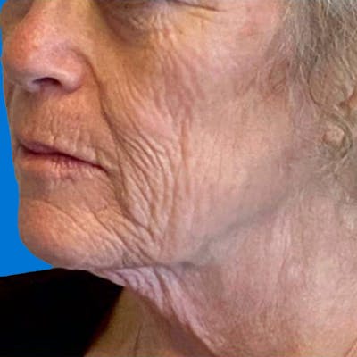 Junera Before & After Gallery - Patient 381316 - Image 1