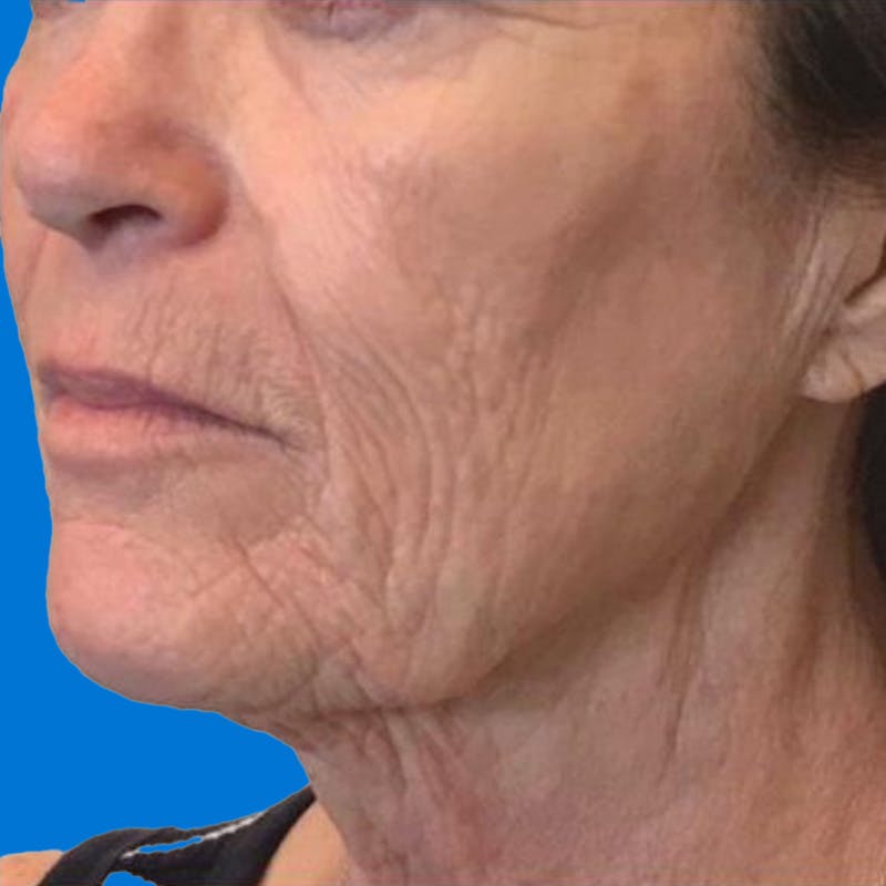 Junera Before & After Gallery - Patient 381316 - Image 2