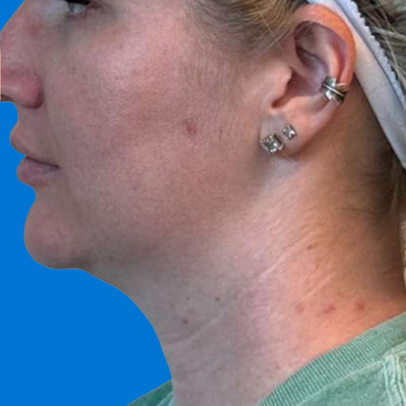 Junera Before & After Gallery - Patient 481186 - Image 2