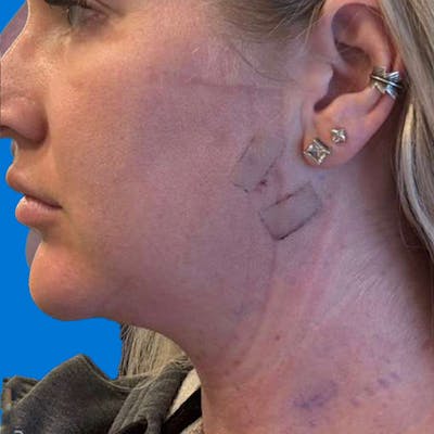 Junera Before & After Gallery - Patient 481186 - Image 1