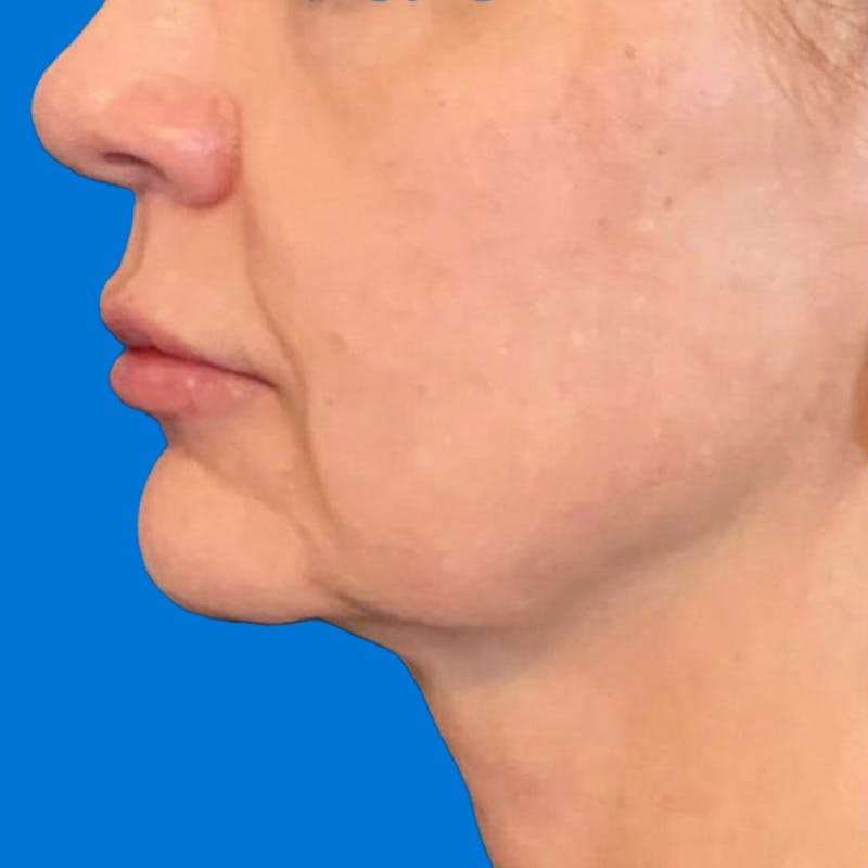 Junera Before & After Gallery - Patient 346309 - Image 1