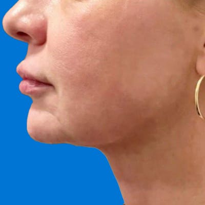 Junera Before & After Gallery - Patient 346309 - Image 2