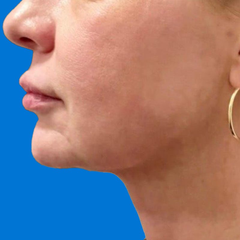 Junera Before & After Gallery - Patient 346309 - Image 2