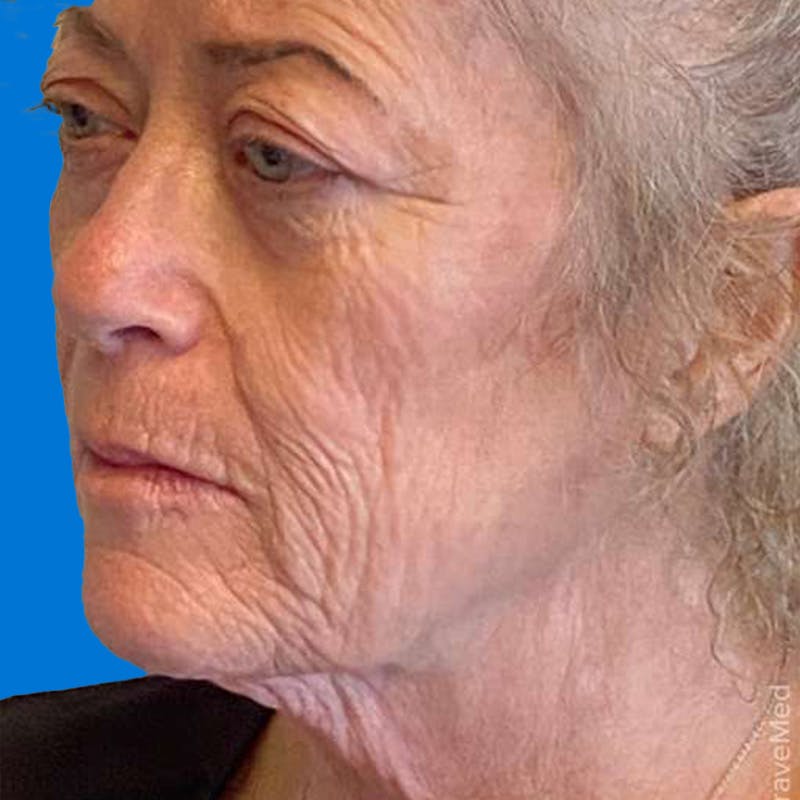 Junera Before & After Gallery - Patient 208625 - Image 1