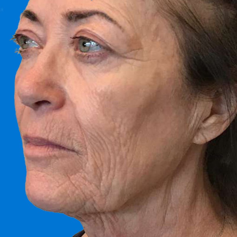 Junera Before & After Gallery - Patient 208625 - Image 2