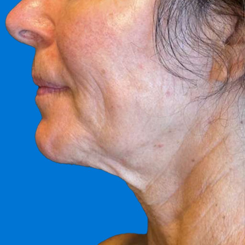 Junera Before & After Gallery - Patient 301002 - Image 1