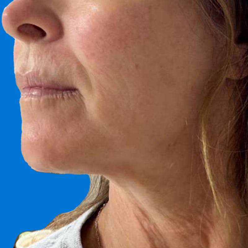 Junera Before & After Gallery - Patient 226033 - Image 2