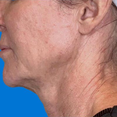 Junera Before & After Gallery - Patient 238340 - Image 1