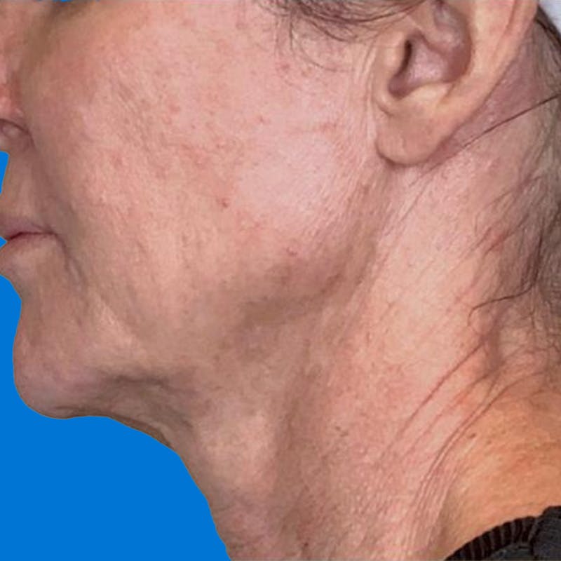 Junera Before & After Gallery - Patient 238340 - Image 1