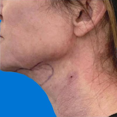 Junera Before & After Gallery - Patient 238340 - Image 2