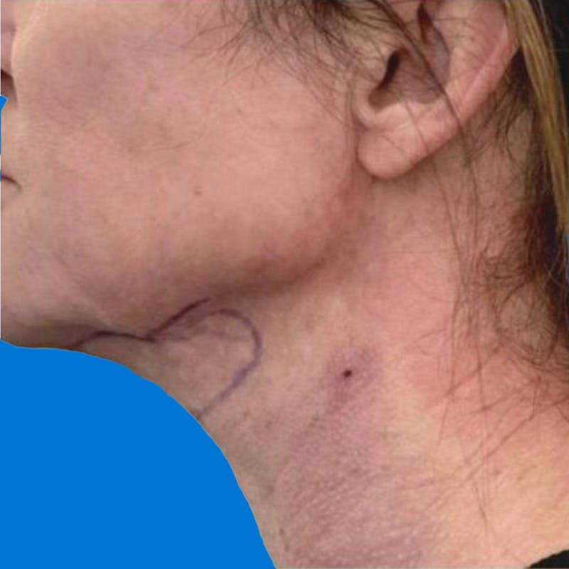 Junera Before & After Gallery - Patient 238340 - Image 2