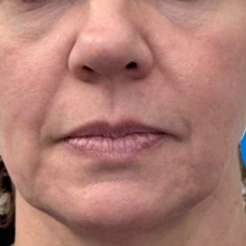 Junera Before & After Gallery - Patient 111447 - Image 1