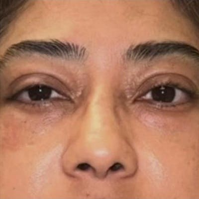 Junera Before & After Gallery - Patient 181331 - Image 2