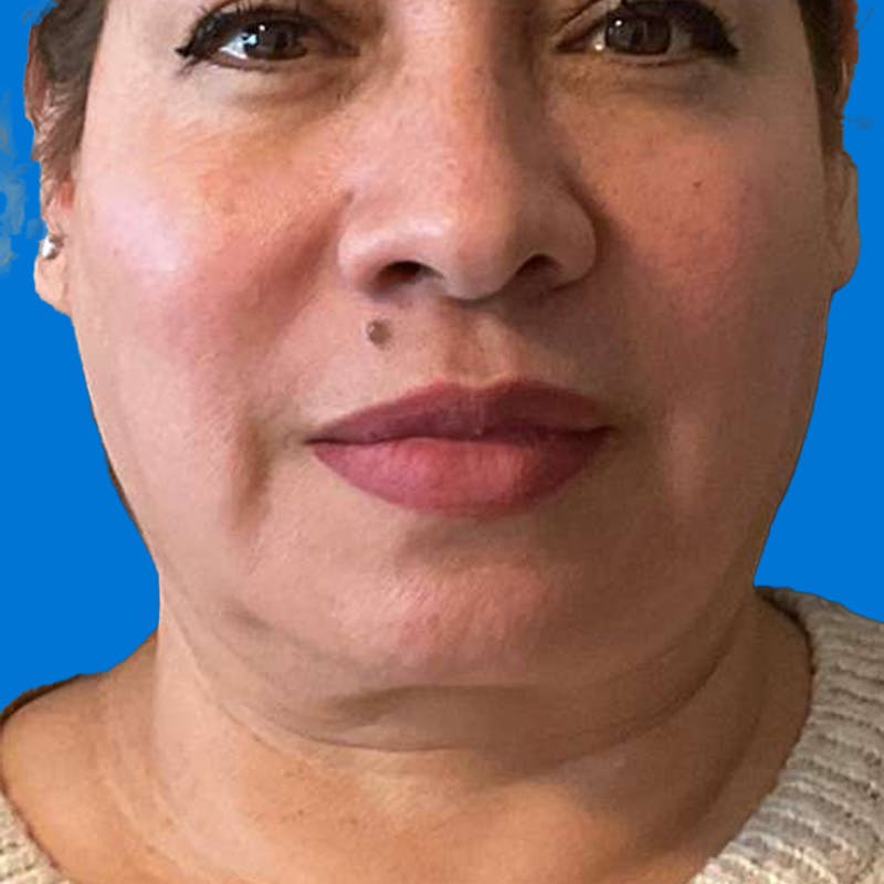 Junera Before & After Gallery - Patient 284744 - Image 1