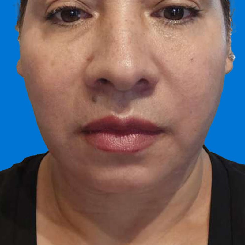 Junera Before & After Gallery - Patient 284744 - Image 2