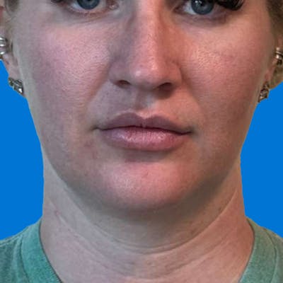 Junera Before & After Gallery - Patient 363971 - Image 1