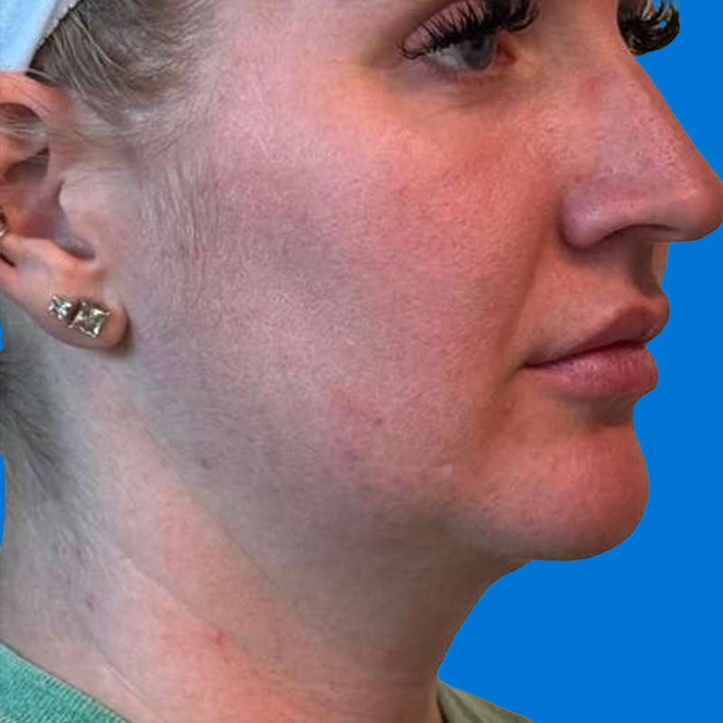 Junera Before & After Gallery - Patient 363971 - Image 3