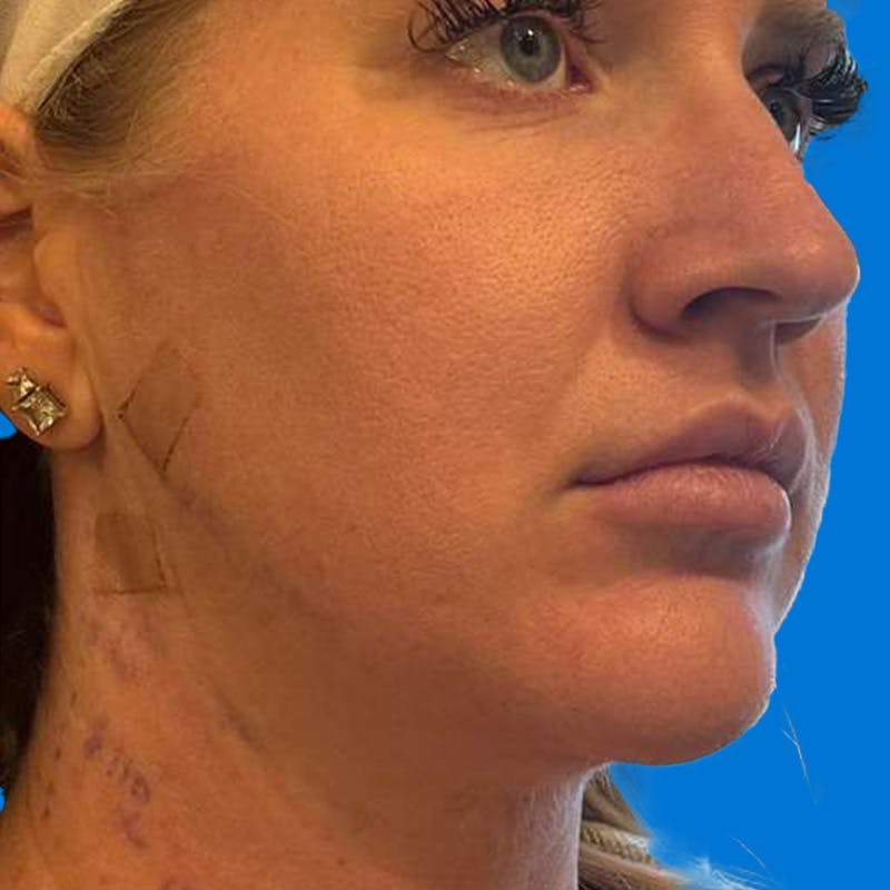 Junera Before & After Gallery - Patient 363971 - Image 4