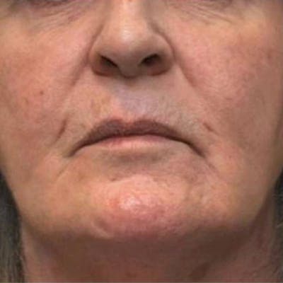 Junera Before & After Gallery - Patient 250436 - Image 1