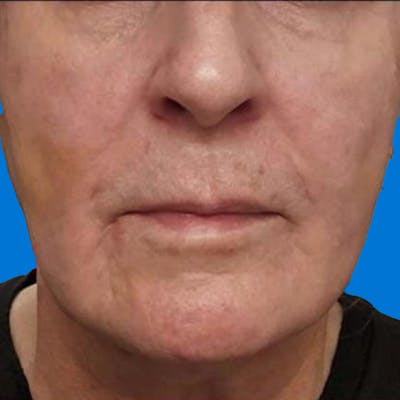 Junera Before & After Gallery - Patient 250436 - Image 2