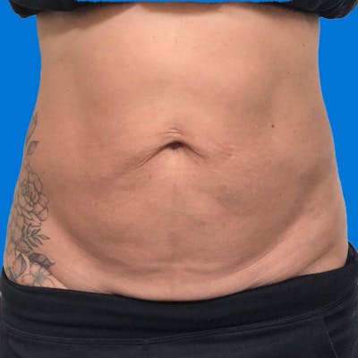 Junera Before & After Gallery - Patient 166618 - Image 1