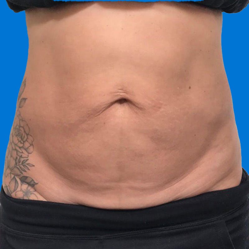 Junera Before & After Gallery - Patient 166618 - Image 1
