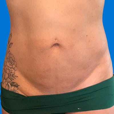 Junera Before & After Gallery - Patient 166618 - Image 2