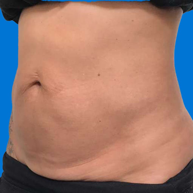 Junera Before & After Gallery - Patient 166618 - Image 3