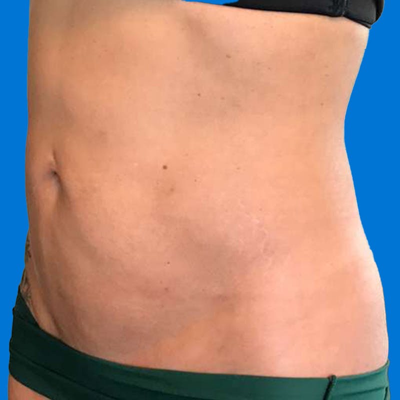 Junera Before & After Gallery - Patient 166618 - Image 4