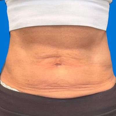 Junera Before & After Gallery - Patient 368664 - Image 1