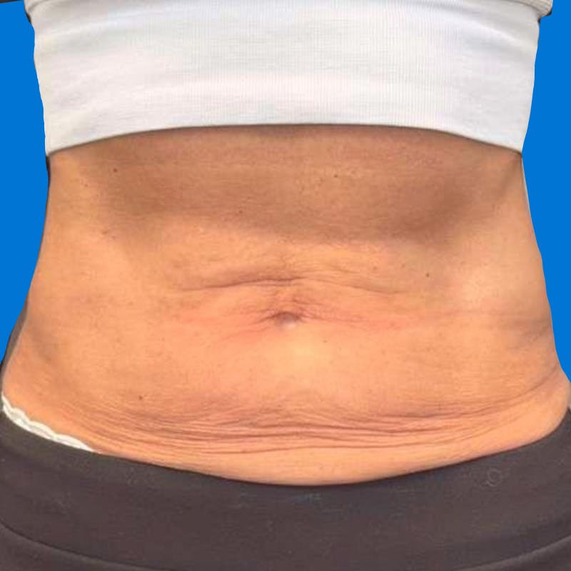 Junera Before & After Gallery - Patient 368664 - Image 1