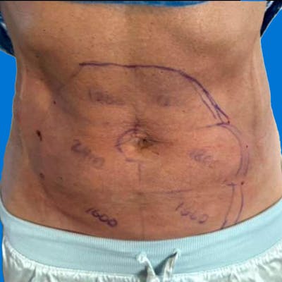 Junera Before & After Gallery - Patient 368664 - Image 2