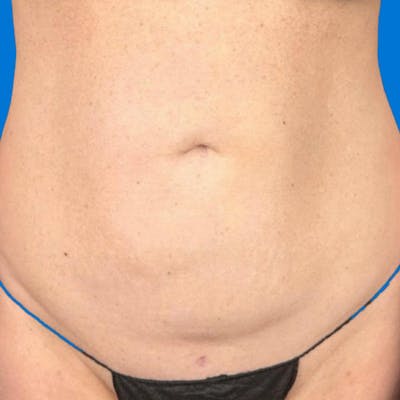 Junera Before & After Gallery - Patient 187610 - Image 1
