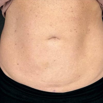 Junera Before & After Gallery - Patient 187610 - Image 2