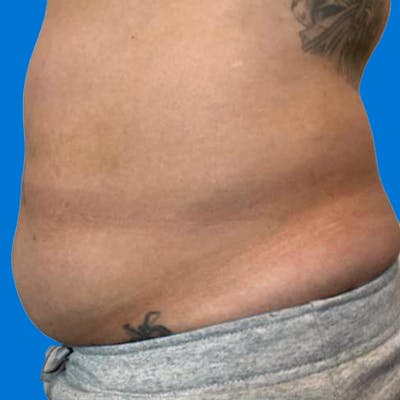 Junera Before & After Gallery - Patient 302651 - Image 1
