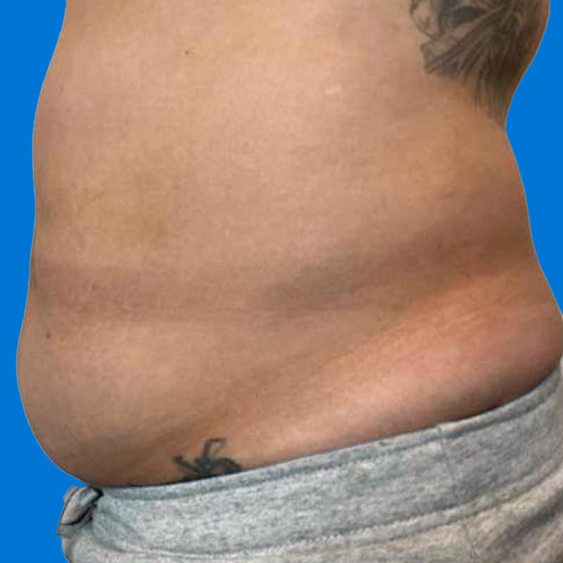 Junera Before & After Gallery - Patient 302651 - Image 1