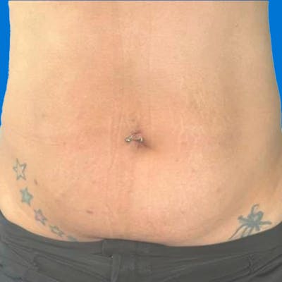 Junera Before & After Gallery - Patient 219833 - Image 2