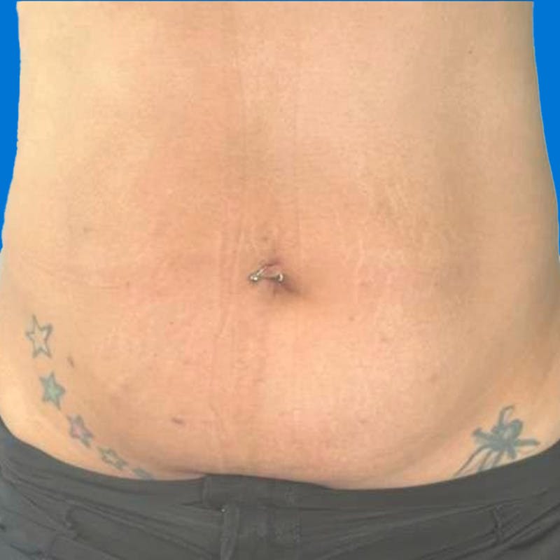 Junera Before & After Gallery - Patient 219833 - Image 2