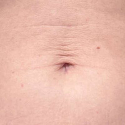 Junera Before & After Gallery - Patient 326331 - Image 1