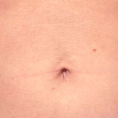 Junera Before & After Gallery - Patient 326331 - Image 2