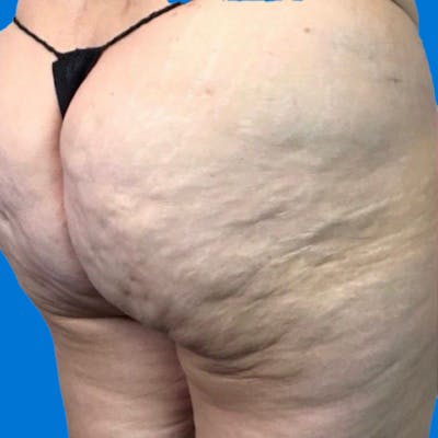 Junera Before & After Gallery - Patient 255146 - Image 1