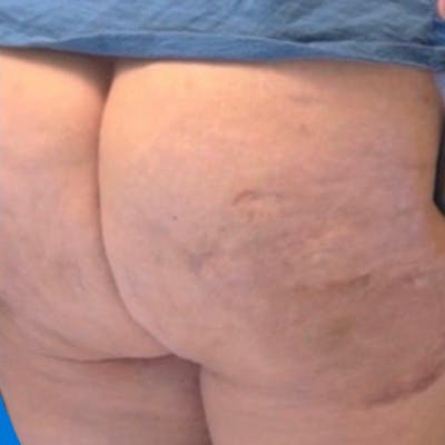 Junera Before & After Gallery - Patient 255146 - Image 2
