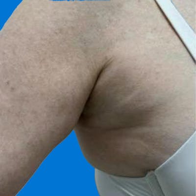 Junera Before & After Gallery - Patient 144575 - Image 1