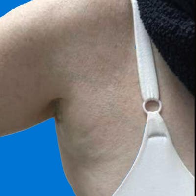 Junera Before & After Gallery - Patient 144575 - Image 2