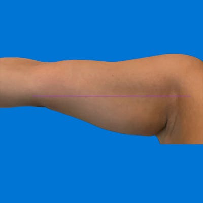 Junera Before & After Gallery - Patient 227267 - Image 1