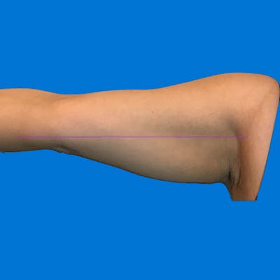 Junera Before & After Gallery - Patient 227267 - Image 2
