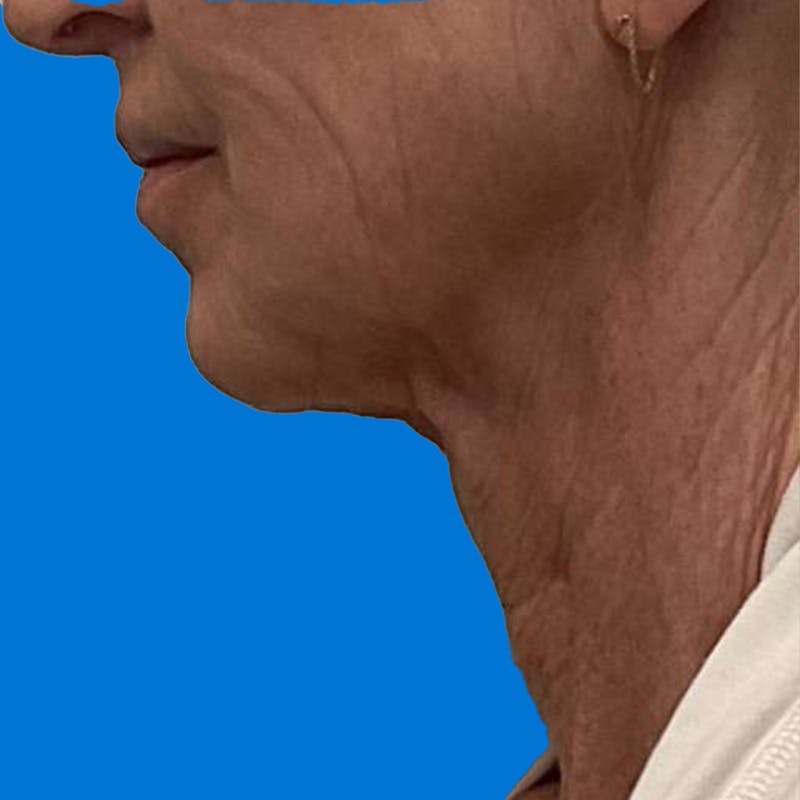 Junera Before & After Gallery - Patient 147121 - Image 1